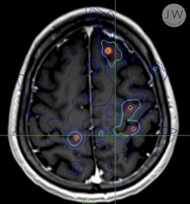 Top view scan of brain metastases after CyberKnife stereotactic radiosurgery