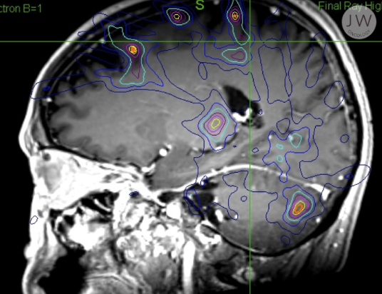 Scan of brain metastases after CyberKnife stereotactic radiosurgery