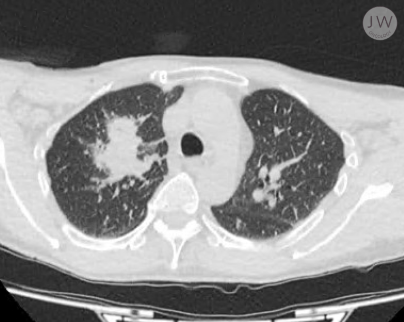 Image of a patient's lungs, with a large tumour.