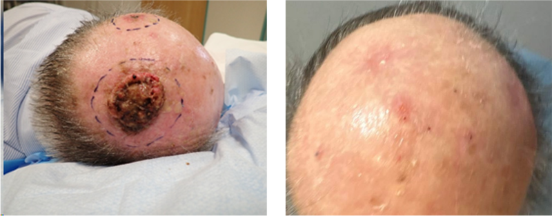 Squamous cell skin cancer before and after radiotherapy showing an excellent result with good post-treatment appearance